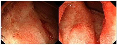 Case Report: Development of Type 1 Autoimmune Pancreatitis in an Adolescent With Ulcerative Colitis Mimicking Pancreatic Cancer